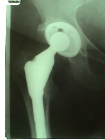 DePuy Stability Stem, Duraloc Cup (Implant 168)